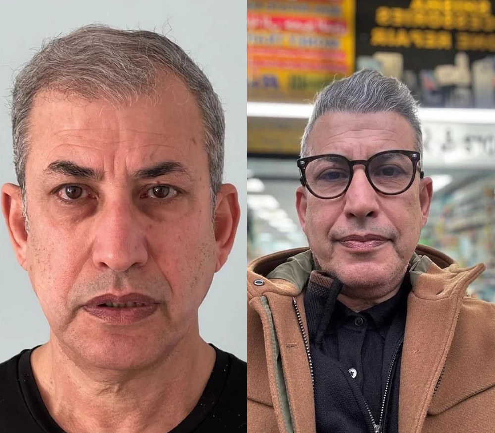 4000 Follicles DHI Hair transplant 12 Month Result