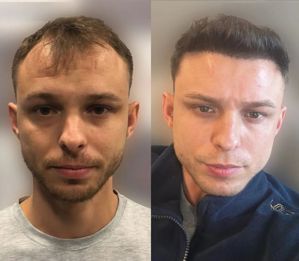 4500 Follicles FUE Sapphire Hair transplant 12 Month Result
