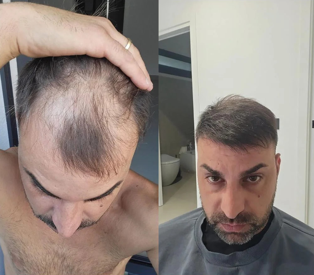 5000 Follicles DHI Hair transplant 12 Month Result