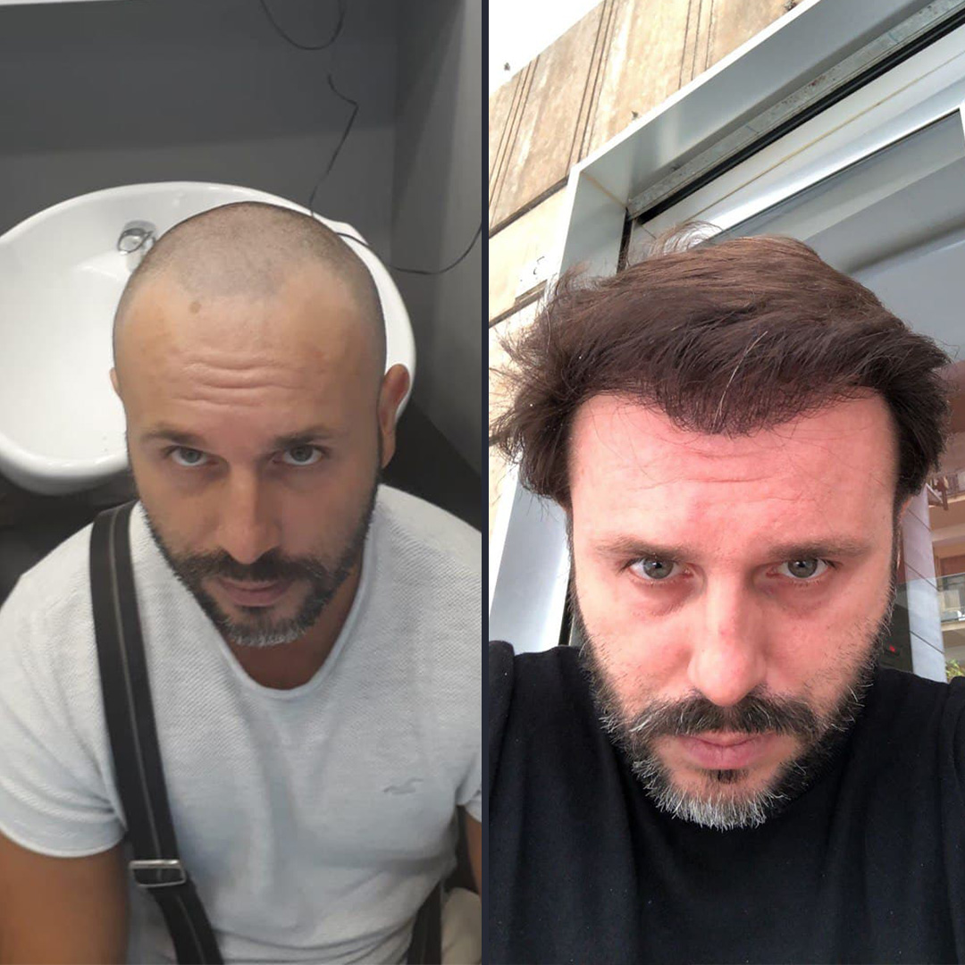bf1 3700 Follicles DHI Hair transplant 12 Month Result