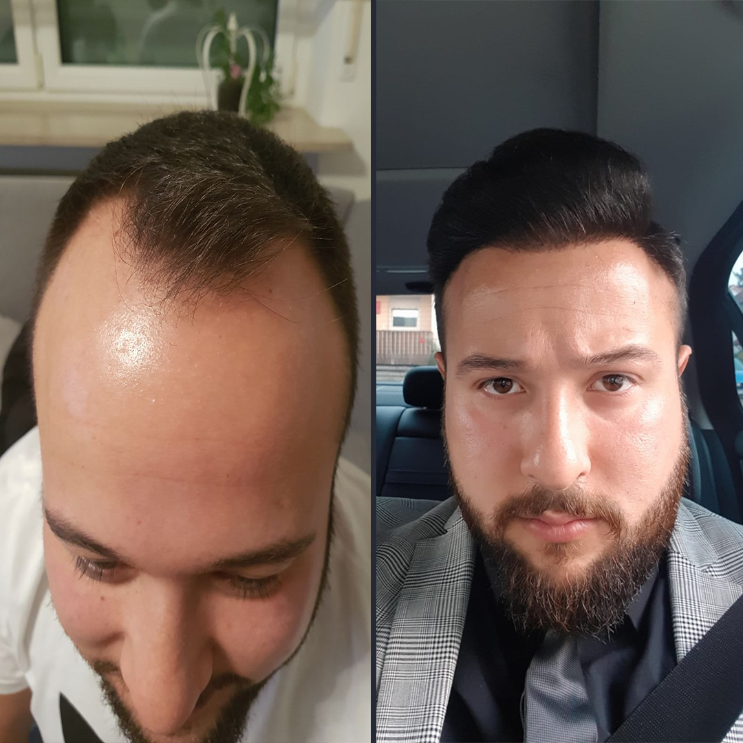 DHI Hair transplant Result 4500 Follicles DHI Hair transplant 9 Month Result