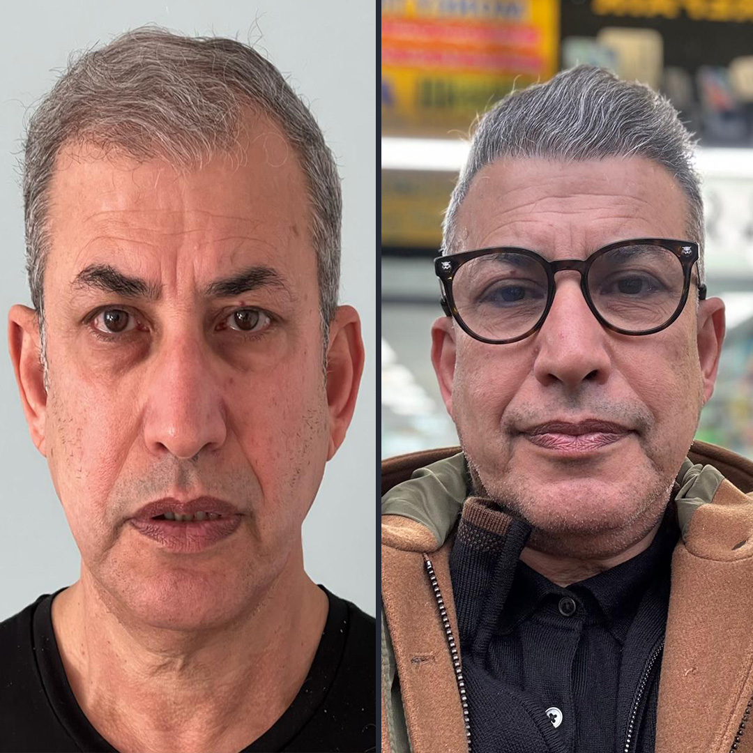 bf5 3200 Follicles DHI Hair transplant 12 Month Result