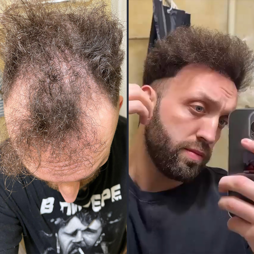 DHI Hair transplant 12 Month Result 5600 DHI Hair transplant 12 Month Result