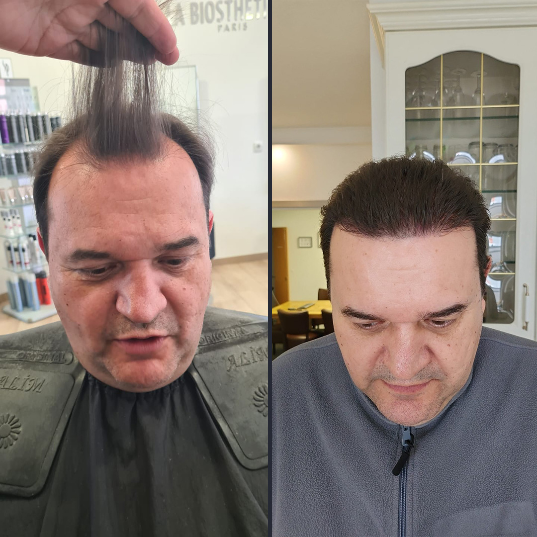 DHI Hair transplant 9 Month Result 4400 DHI Hair transplant 9 Month Result